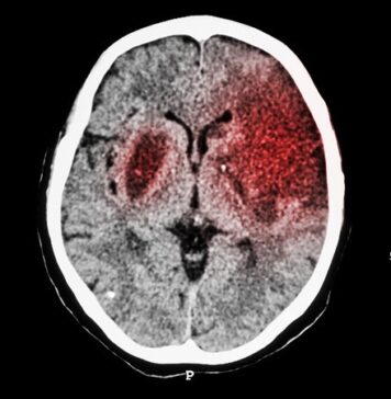 Is There a Need for tPA Before Thrombectomy in Stroke? | Nutrition Fit