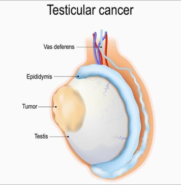 Surveillance After Testicular Cancer: Reduced Radiation Exposure | Nutrition Fit