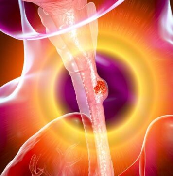 Age Should Not Prevent Aggressive Esophageal Cancer Treatment | Nutrition Fit