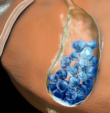 Mitochondrial DNA Variant Increases Gallstone Risk | Nutrition Fit