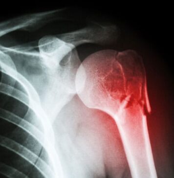 Abdominal Aortic Calcification May Further Raise Fracture Risk | Nutrition Fit