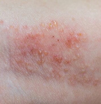 Ruxolitinib Cream for AD Is in Regulatory Home Stretch | Nutrition Fit