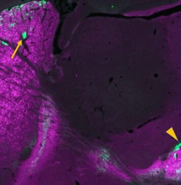 Gene Changes Linked to Severe Repetitive Behaviors | Nutrition Fit