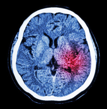 Kallikrein Formulation Appears Safe in Ischemic Stroke | Nutrition Fit