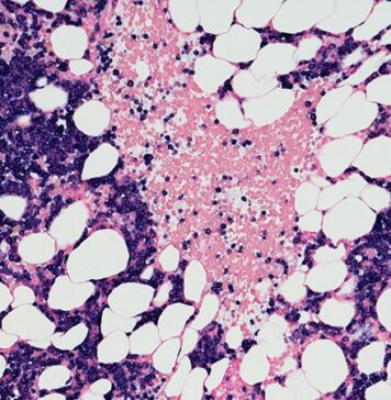 ‘Phenomenal’ Results with CAR T-Cells in R/R Multiple Myeloma | Nutrition Fit