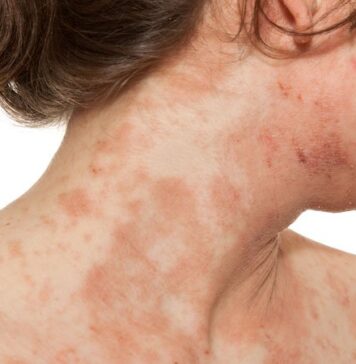 Novel Oral Agent Effective in Teens With Atopic Dermatitis | Nutrition Fit