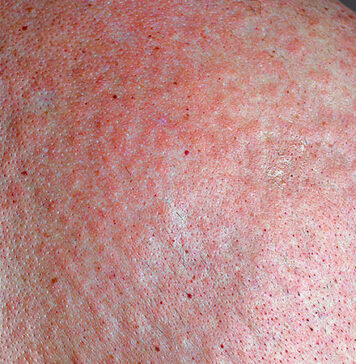 Psoriasis Pathophysiology Insights Carry Treatment Implications | Nutrition Fit