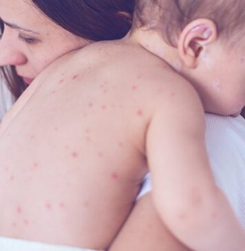 A Single-County Measles Outbreak Cost Millions, Study Finds | Nutrition Fit