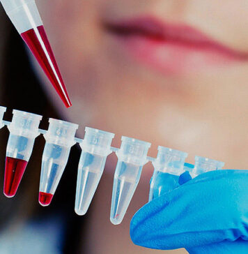 Low Concordance Between Troponin Assays for ACS | Nutrition Fit