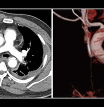 Certain Antihypertensives Tied to Benefit After Aortic Dissection | Nutrition Fit