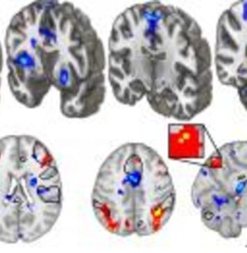 The Most Detailed Look Yet at the Neuroscience of Placebo Effects | Nutrition Fit