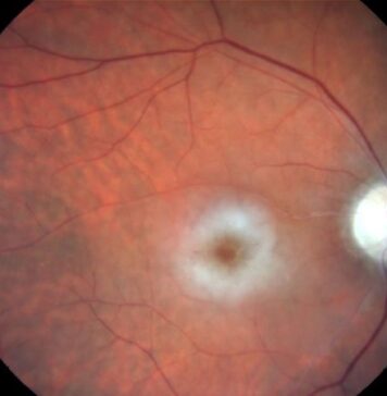Central Retinal Artery Occlusion a ‘Medical Emergency’ | Nutrition Fit
