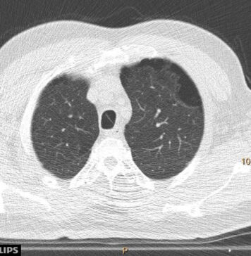 USPSTF Expands Criteria for Lung Cancer Screening | Nutrition Fit
