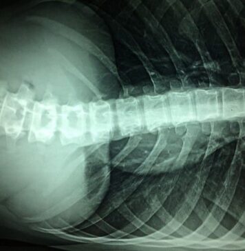 A New Potential for Functional Recovery After Spinal Cord Injury | Nutrition Fit