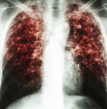 As Peru Battles COVID-19, Tuberculosis Finds New Footing | Nutrition Fit