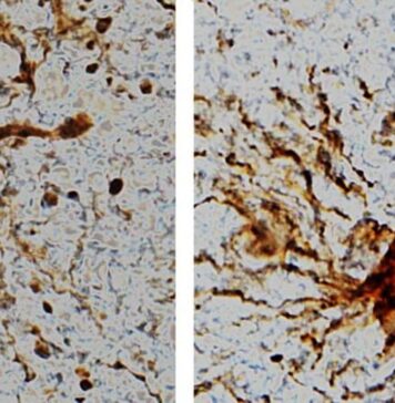 ‘Zombie’ Genes? Some Genes Come to Life in the Brain After Death | Nutrition Fit