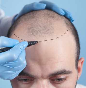 Are The Results Of FUE Hair Transplant Worthful? fue hair transplant near me