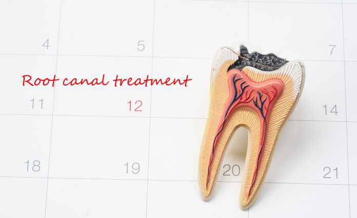 root canals