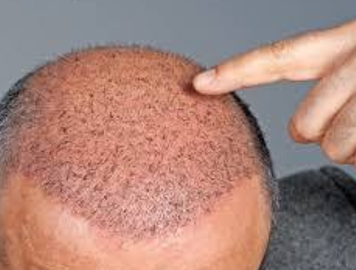 5 Great Reasons You Should Consider A Hair Transplant