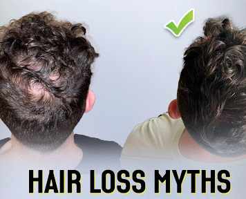 10 Hair Loss Myths That Can Be Confusing For Men